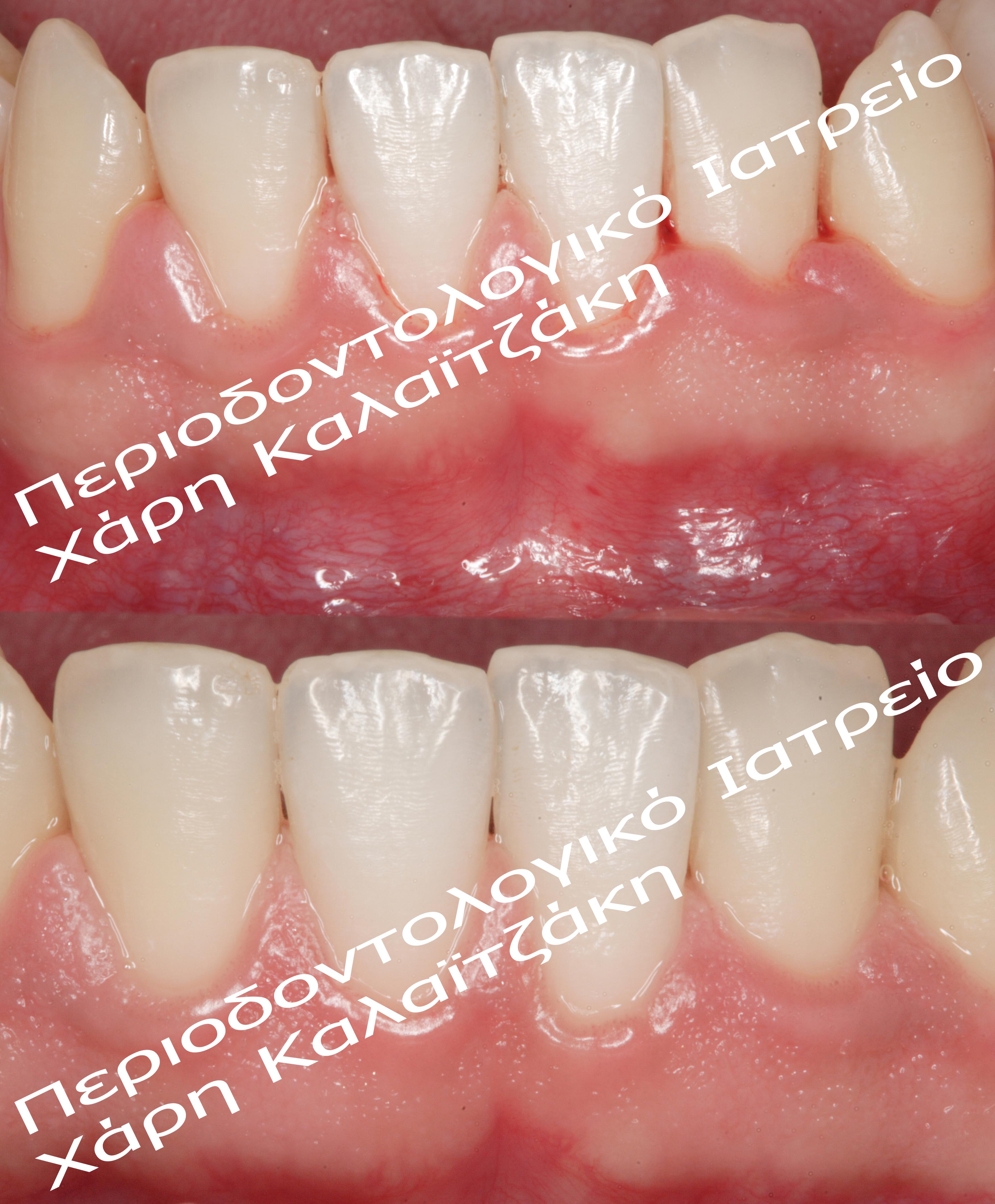 Before & after treatment_ΒΚ