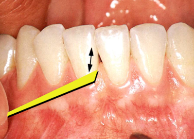 Το οδοντικό νήμα αγκαλιάζει την πλαϊνή επιφάνεια του δοντιού & κινείται πάνω-κάτω