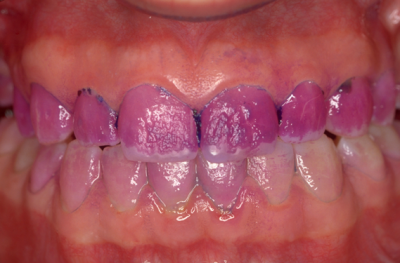 Δόντια χρωματισμένα με αποκαλυπτικό διάλυμα